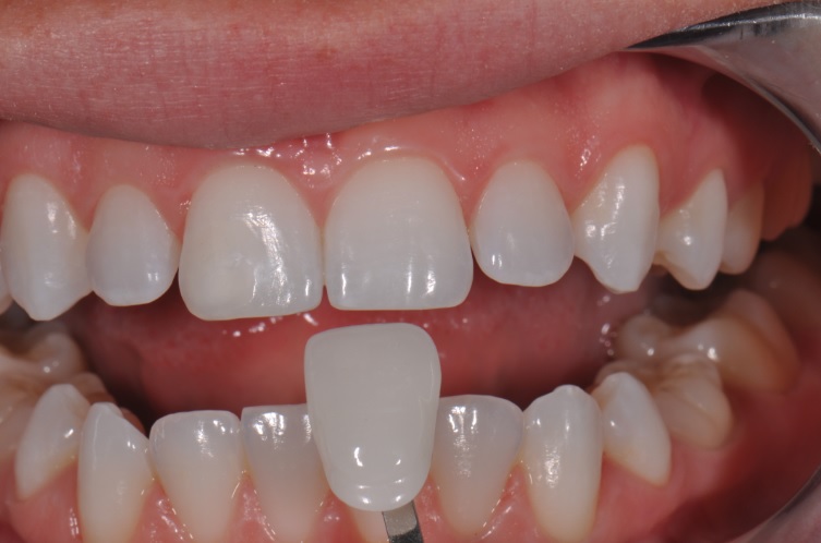 Dental Veneers: Materials, Risks and Maintenance