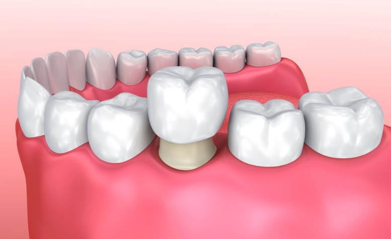 Dental Crowns: Benefits, Risks and Alternatives