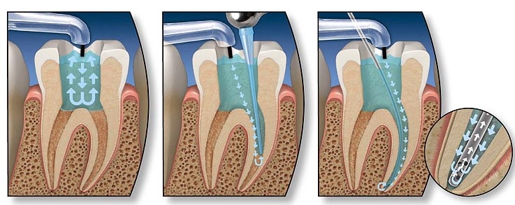 Root Canal Problems: Causes and Assessment