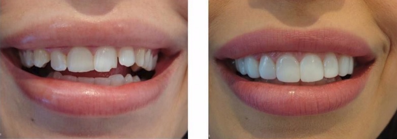 Composite Veneers: Procedure and Considerations