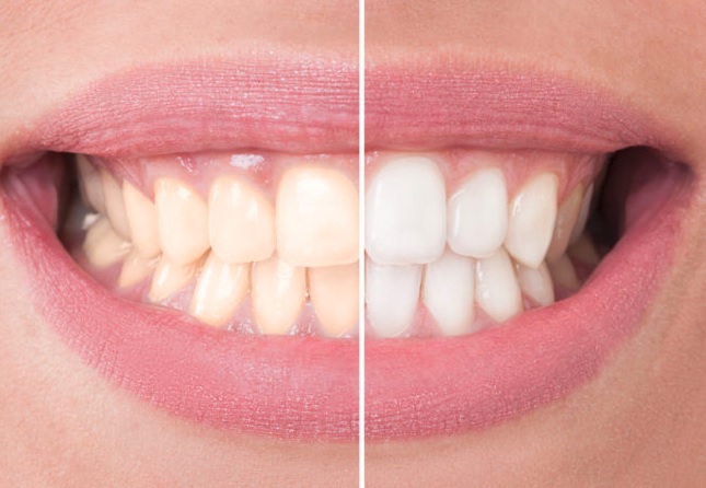 Whitening Options: In-Clinic and Take-Home Treatment