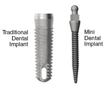 Mini and Standard Implants: What to Compare
