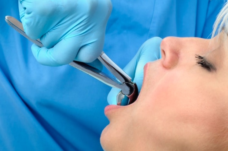Tooth Extraction: Planning and Aftercare