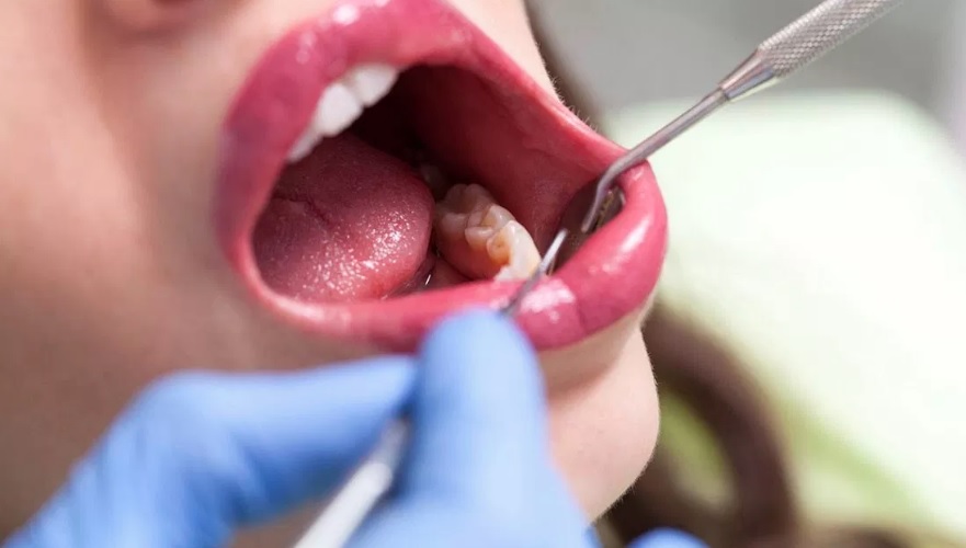 Tooth Extraction: Planning and Aftercare