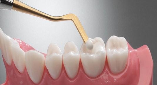 When Do Dental Fillings Need Replacing?