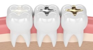 Tooth Fillings: Assessment, Costs and Ongoing Care