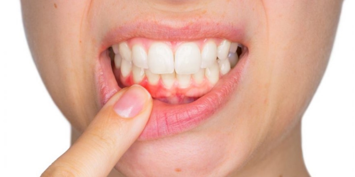 Gum Disease: Signs, Assessment and Ongoing Care
