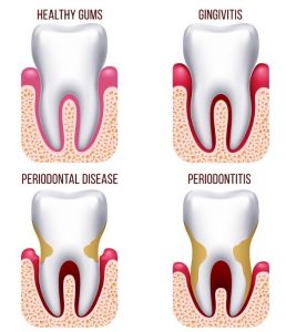 Gum Disease: Signs, Assessment and Ongoing Care