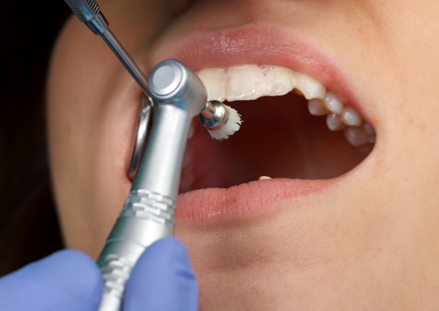 Everyday Teeth Cleaning: Habits and Dental Advice
