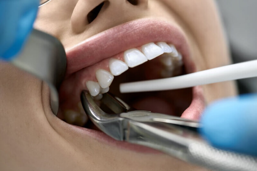 Tooth Removal Fees: Procedure and Aftercare