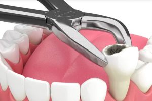 When Might a Tooth Need Removal?