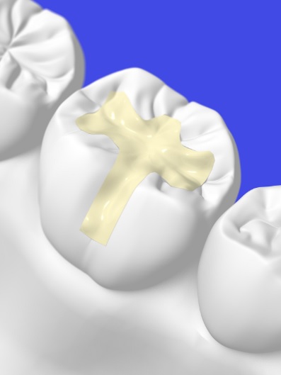 Dental Filling Materials: How Choices Are Made