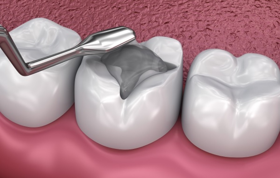 Dental Filling Materials: How Choices Are Made