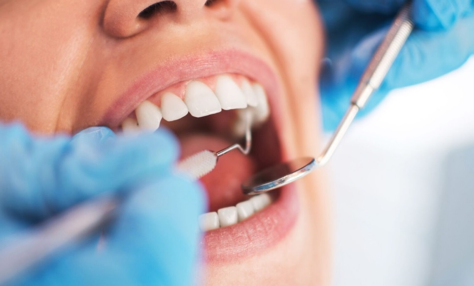 Teeth Scaling: Purpose, Limits and Aftercare