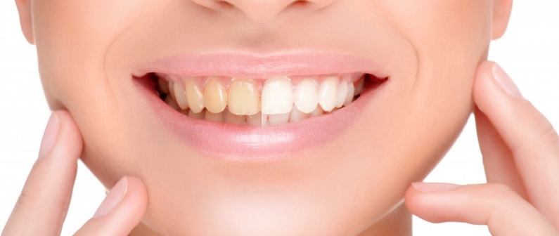 Professional teeth whitening north sydney
